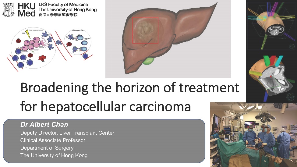 Broadening the horizon of treatment of hepatocellular carcinoma